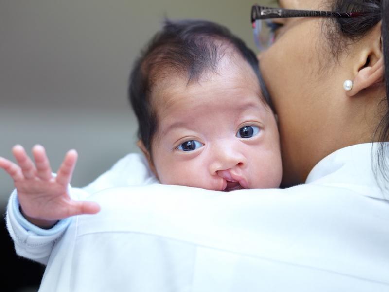 baby with cleft palette being held my physician