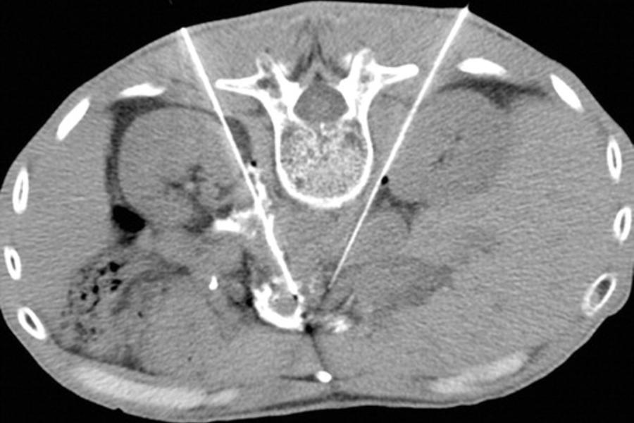 Radiology Celiac Neurolysis picture